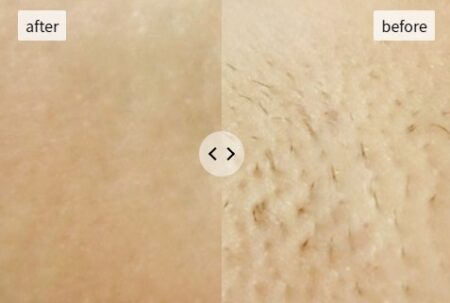 jovs脱毛器　ビフォーアフター